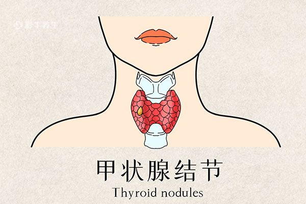 甲状腺结节怎么治疗最好的方法