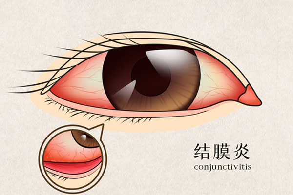 眼屎多怎么办 眼屎多的原因