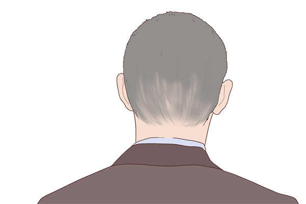 掉发多头皮屑多是怎么回事  脱发头皮屑多的原因