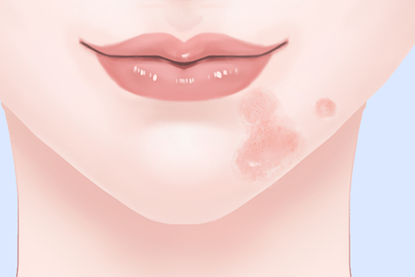 嘴唇上长疱疹是什么原因引起的 嘴唇上长疱疹的相关知识