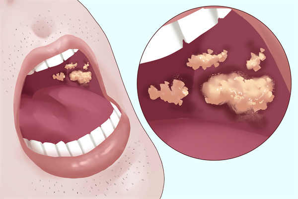 口腔溃疡的症状 怎么判断口腔溃疡