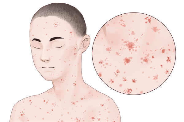 水痘的症状表现 水痘应该吃什么食物