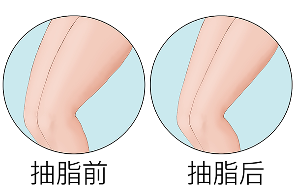 光纤溶脂的危害 光纤溶脂的后果