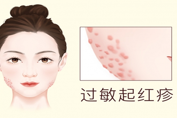 过敏可以吃羊肉吗
